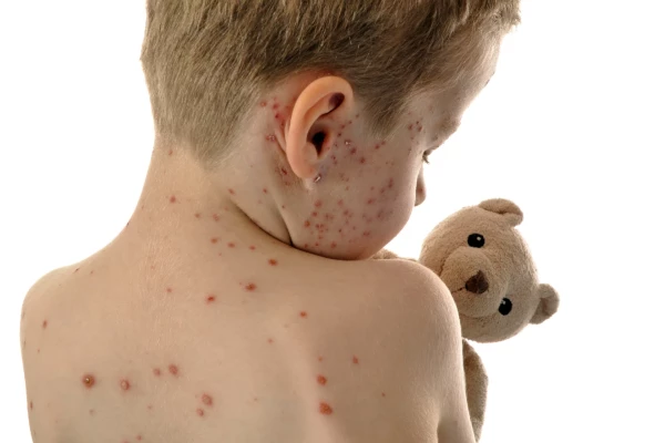 Measles cases on the rise