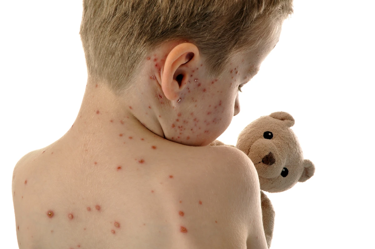 image of a child with measles